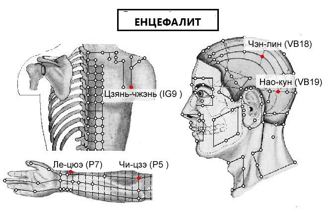 ЕНЦЕФАЛИТ | ЕЛЕКТРОПУНКТУРА