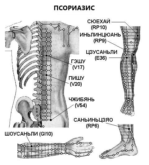 ПСОРИАЗИС | ЕЛЕКТРОПУНКТУРА