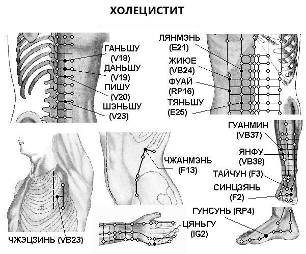 ХОЛЕЦИСТИТ | ЕЛЕКТРОПУНКТУРА