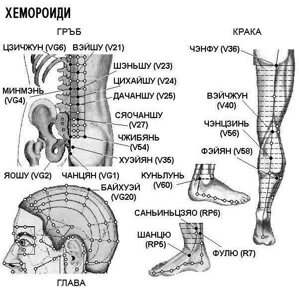ХЕМОРОИДИ | ЕЛЕКТРОПУНКТУРА