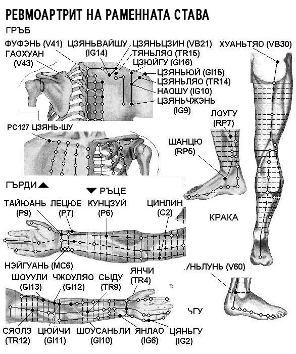 РЕВМОАРТРИТ НА РАМЕННАТА СТАВА | ЕЛЕКТРОПУНКТУРА