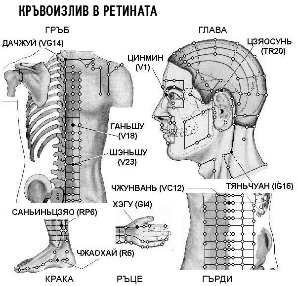 КРЪВОИЗЛИВ В РЕТИНАТА | ЕЛЕКТРОПУНКТУРА