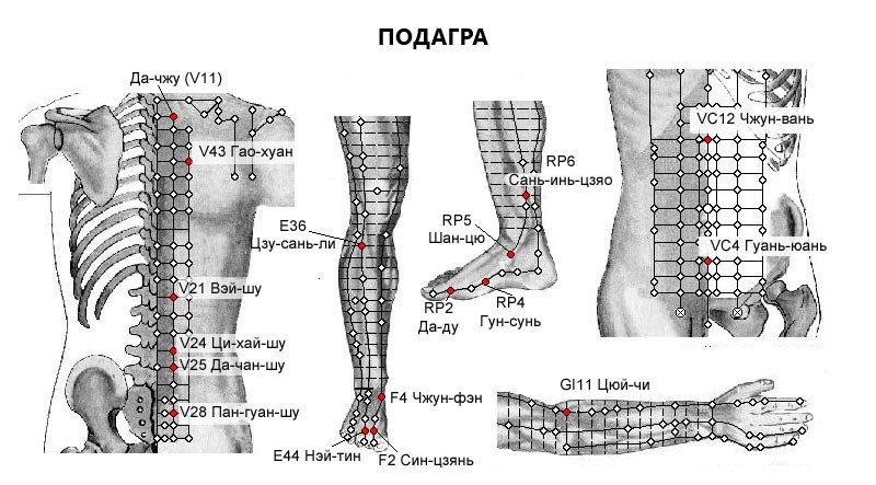ПОДАГРА | ЕЛЕКТРОПУНКТУРА