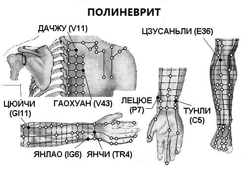 ПОЛИНЕВРИТ | ЕЛЕКТРОПУНКТУРА