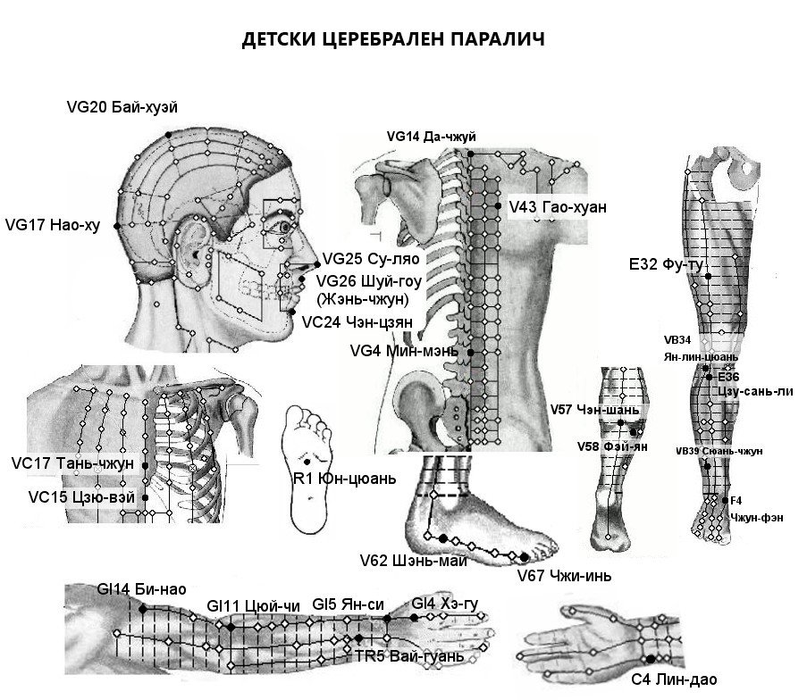 ДЕТСКИ ЦЕРЕБРАЛЕН ПАРАЛИЧ | ЕЛЕКТРОПУНКТУРА