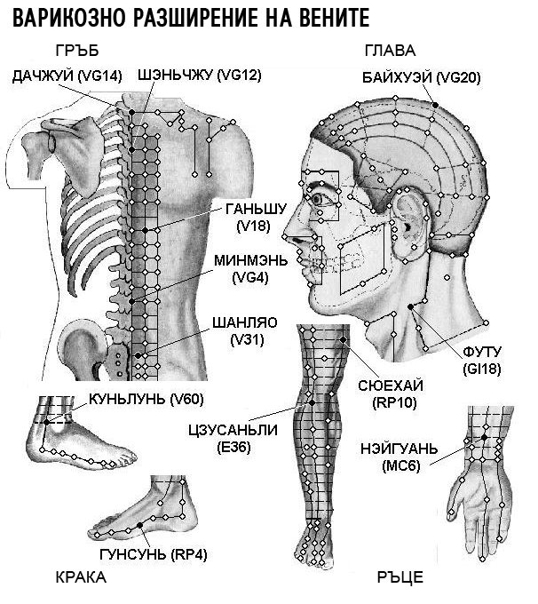ВАРИКОЗНО РАЗШИРЕНИЕ НА ВЕНИТЕ | ЕЛЕКТРОПУНКТУРА