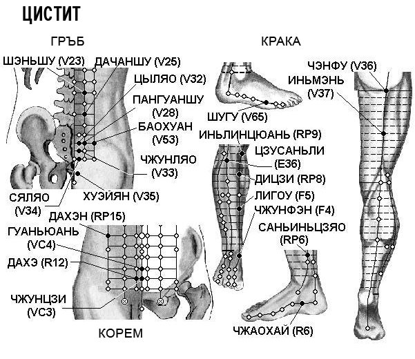 ЦИСТИТ | ЕЛЕКТРОПУНКТУРА