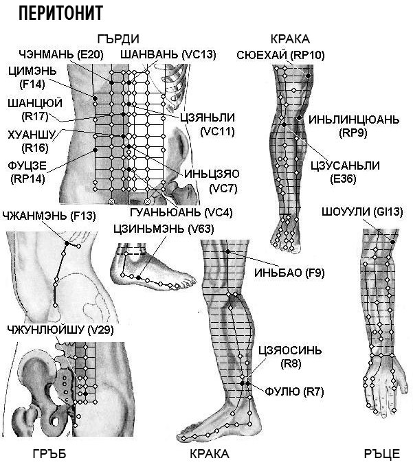 ПЕРИТОНИТ | ЕЛЕКТРОПУНКТУРА