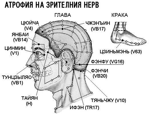 АТРОФИЯ НА ЗРИТЕЛНИЯ НЕРВ | ЕЛЕКТРОПУНКТУРА