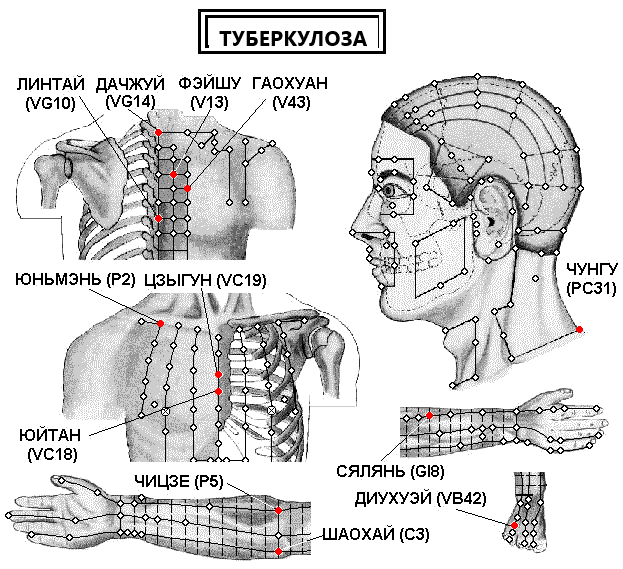 ТУБЕРКОЛОЗА | ЕЛЕКТРОПУНКТУРА