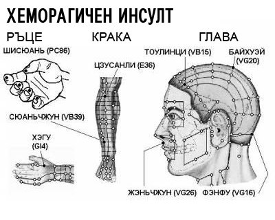 ХЕМОРАГИЧЕН ИНСУЛТ | ЕЛЕКТРОПУНКТУРА
