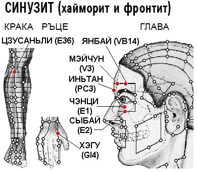 СИНУЗИТ | ЕЛЕКТРОПУНКТУРА