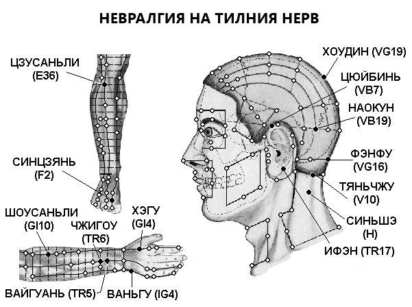 НЕВРАЛГИЯ НА ТИЛНИЯ НЕРВ | ЕЛЕКТРОПУНКТУРА