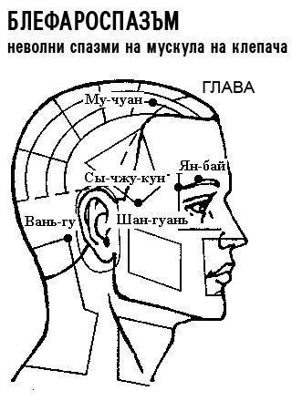 БЛЕФАРОСПАЗЪМ | ЕЛЕКТРОПУНКТУРА
