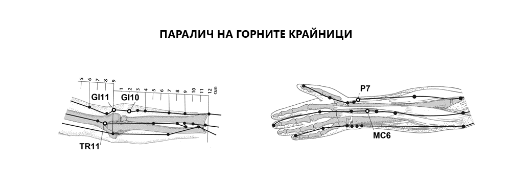 ПАРАЛИЧ | ЕЛЕКТРОПУНКТУРА