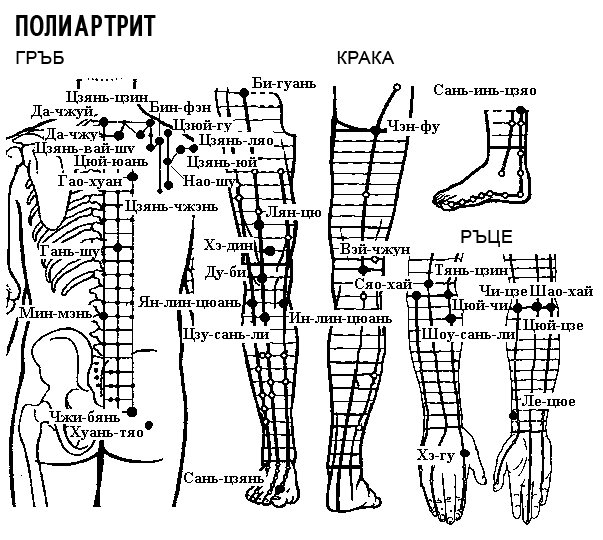 ПОЛИАРТРИТ | ЕЛЕКТРОПУНКТУРА
