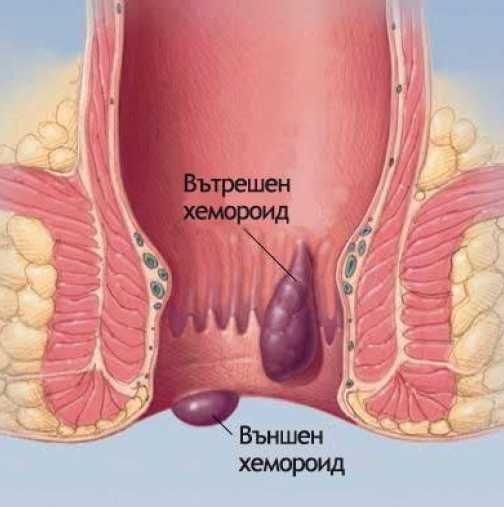 ХЕМОРОИДИ | ЕЛЕКТРОПУНКТУРА