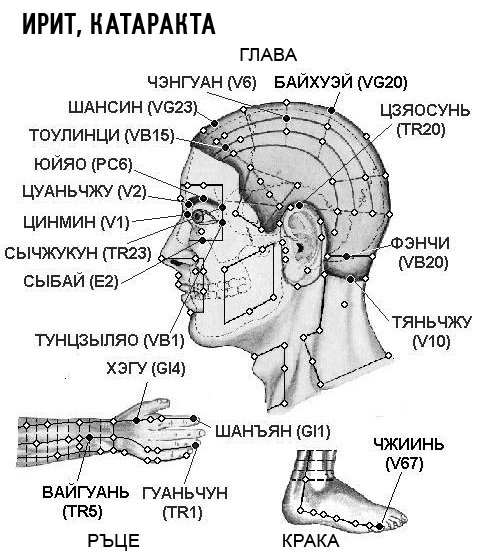 ИРИТ, КАТАРАКТА | ЕЛЕКТРОПУНКТУРА