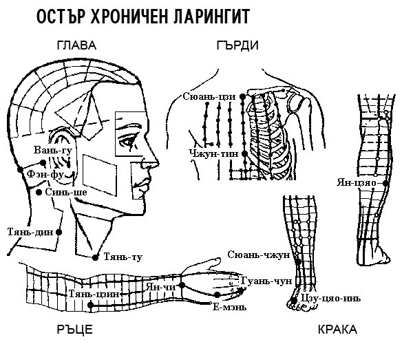 ОСТЪР ХРОНИЧЕН ЛАРИНГИТ | ЕЛЕКТРОПУНКТУРА