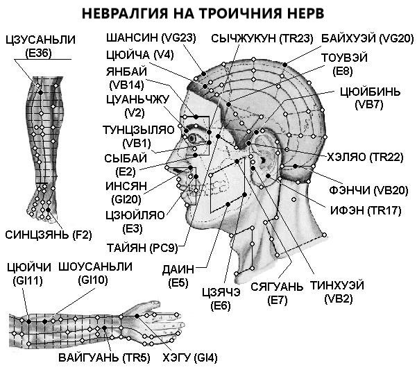 НЕВРАЛГИЯ НА ТРОИЧНИЯ НЕРВ | ЕЛЕКТРОПУНКТУРА