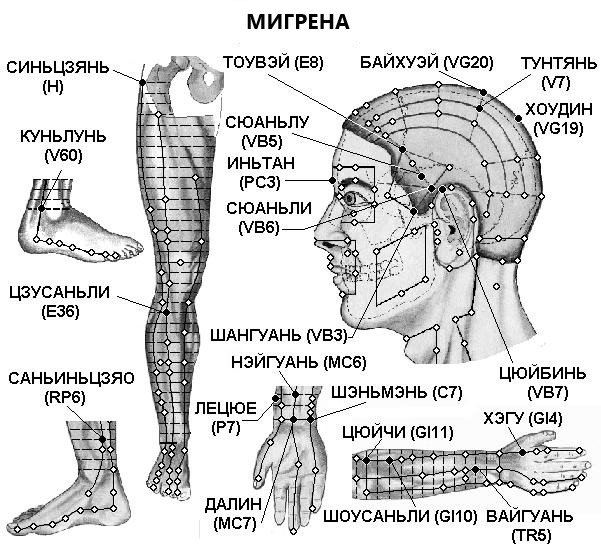 МИГРЕНА | ЕЛЕКТРОПУНКТУРА