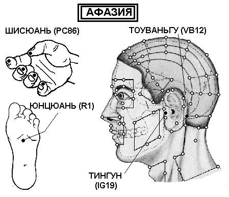АФАЗИЯ | ЕЛЕКТРОПУНКТУРА
