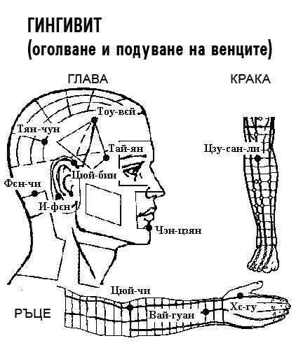 ГИНГВИНИТ | ЕЛЕКТРОПУНКТУРА
