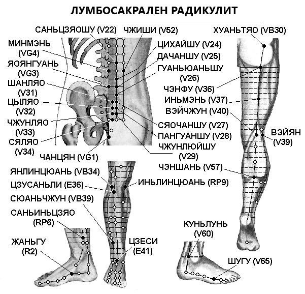 РАДИКУЛИТ | ЕЛЕКТРОПУНКТУРА