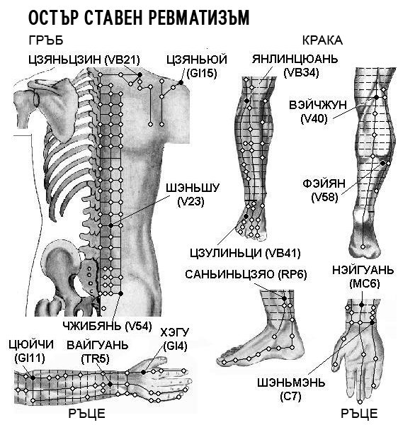 ОСТЪР СТАВЕН РЕВМАТИЗЪМ | ЕЛЕКТРОПУНКТУРА