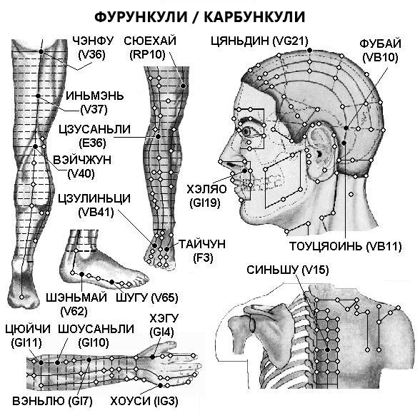 ФУРУНКУЛИ, КАРБУНКУЛИ | ЕЛЕКТРОПУНКТУРА