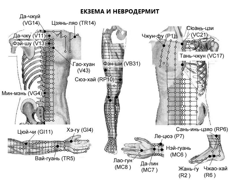 ЕКЗЕМА И НЕВРОДЕРМИТ | ЕЛЕКТРОПУНКТУРА