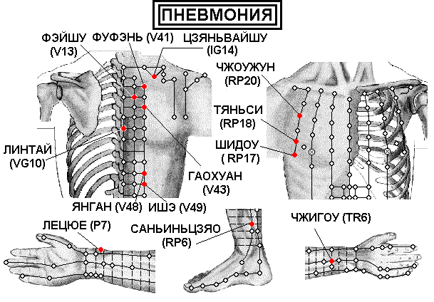 ПНЕВМОНИЯ | ЕЛЕКТРОПУНКТУРА