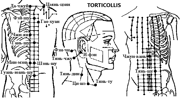 TORTICOLLIS | ЕЛЕКТРОПУНКТУРА