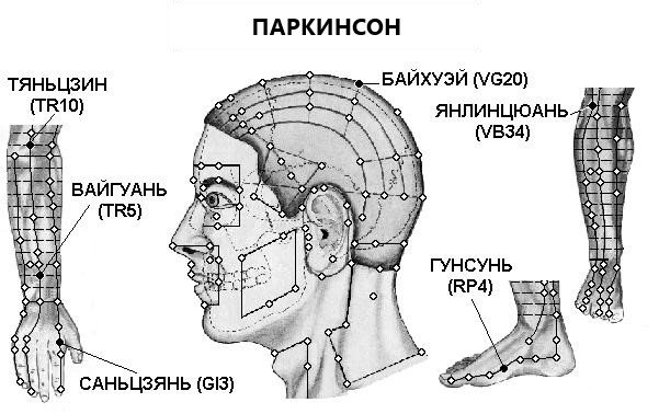 ПАРКИНСОН | ЕЛЕКТРОПУНКТУРА