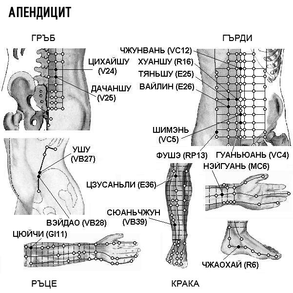АПЕНДИЦИТ | ЕЛЕКТРОПУНКТУРА