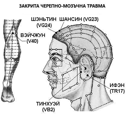 ЗАКРИТА ЧЕРЕПНО-МОЗЪЧНА ТРАВМА | ЕЛЕКТРОПУНКТУРА