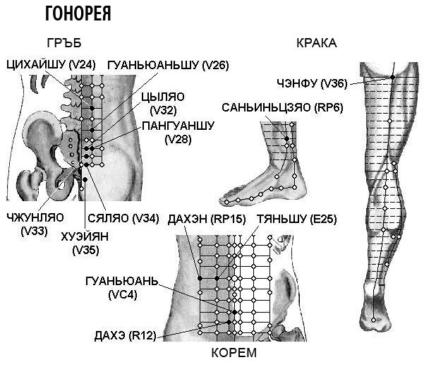 ГОНОРЕЯ | ЕЛЕКТРОПУНКТУРА