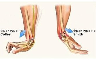 Рехабилитация при фрактура локо типико